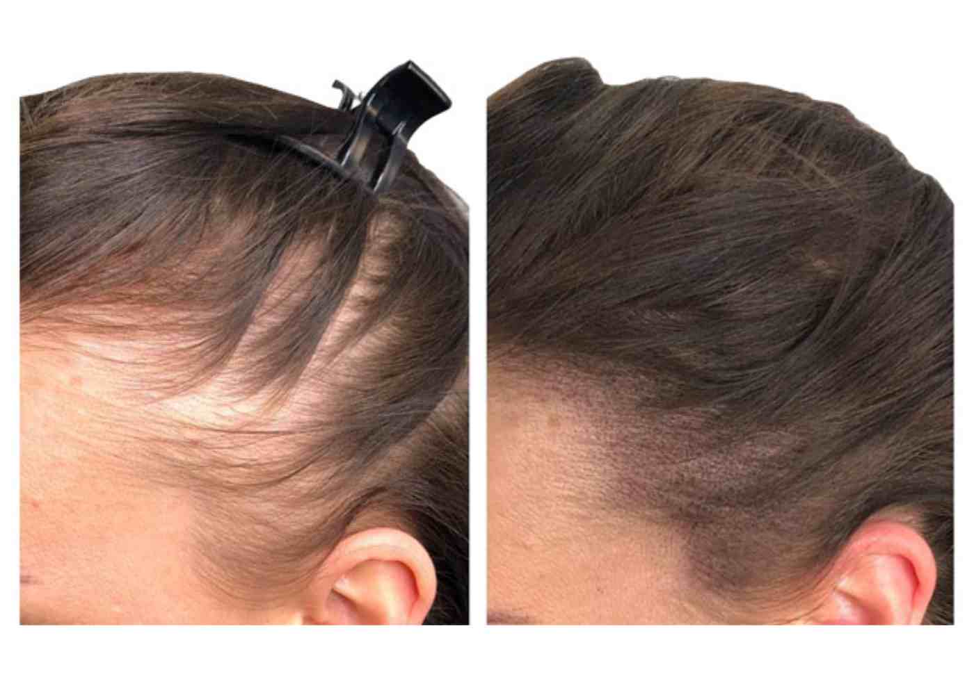 Female scalp micropigmentation before and after results for hair density restoration by Institute of Ink Brisbane