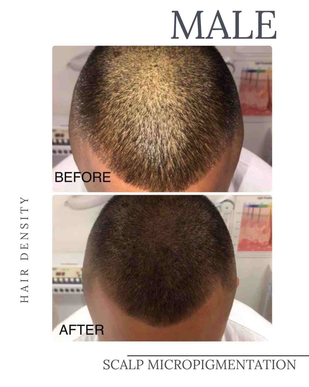 Scalp Micropigmentation Course Brisbane